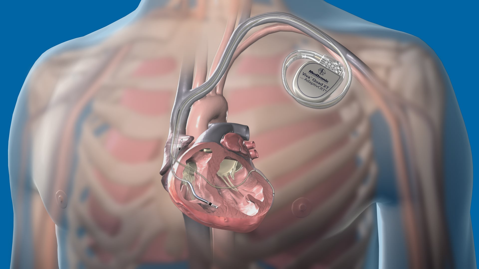 ＩＣＤとＣＲＴ－Ｄの臨床 Heart Failure Medication Adherence Improves Following CRT Device